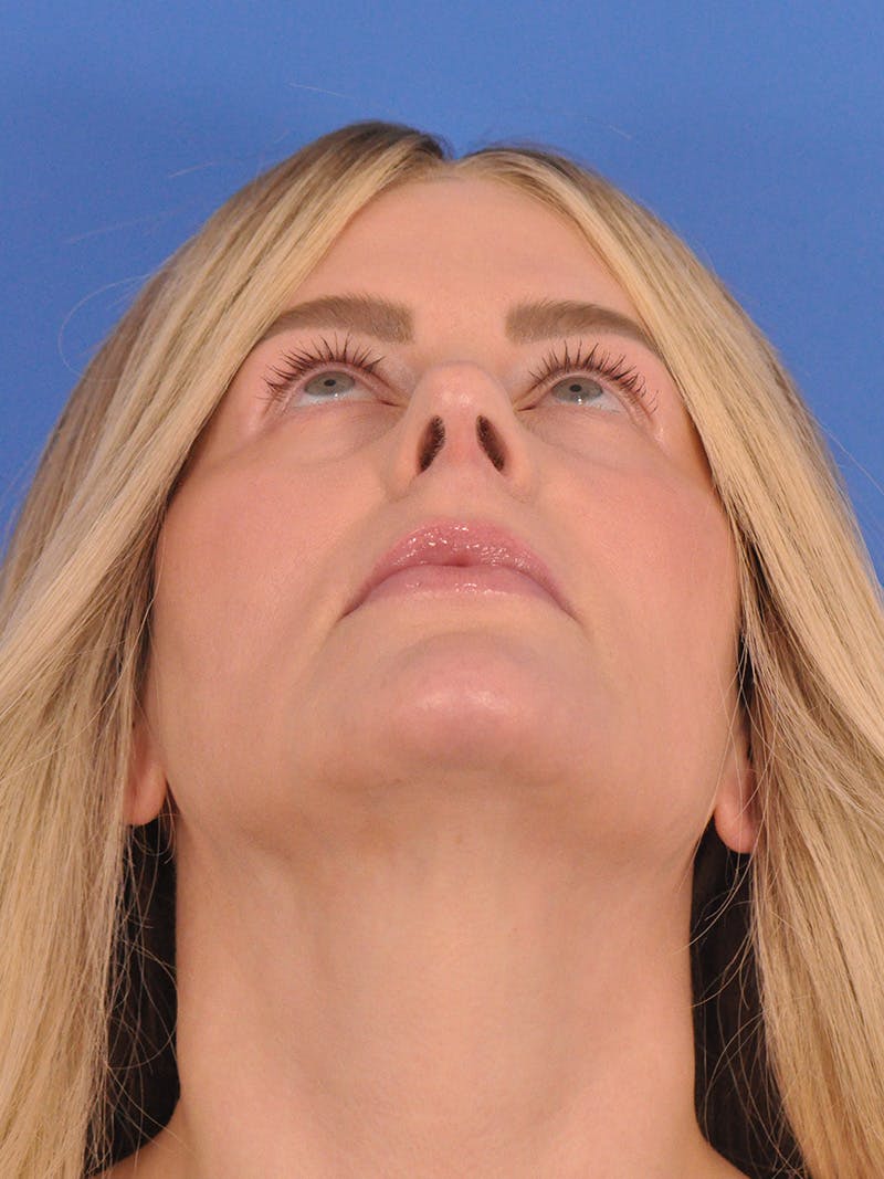 Rhinoplasty Before & After Gallery - Patient 180863483 - Image 12