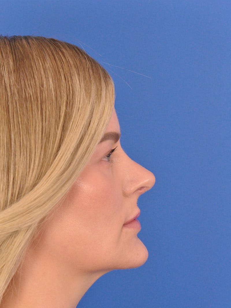 Rhinoplasty Before & After Gallery - Patient 180863483 - Image 2