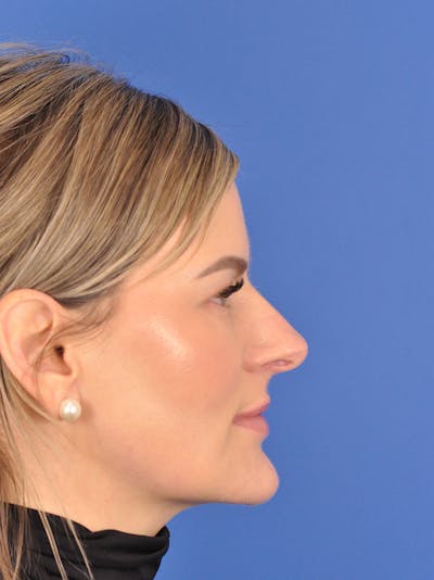 Rhinoplasty Before & After Gallery - Patient 180863483 - Image 1