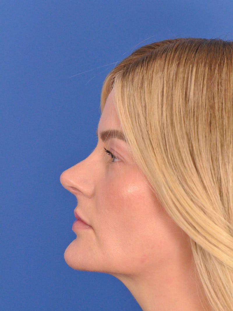 Rhinoplasty Before & After Gallery - Patient 180863483 - Image 10