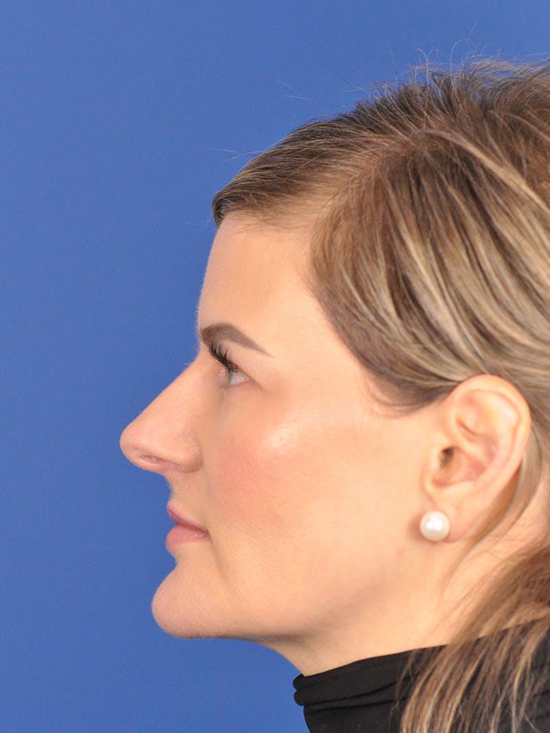 Rhinoplasty Before & After Gallery - Patient 180863483 - Image 9
