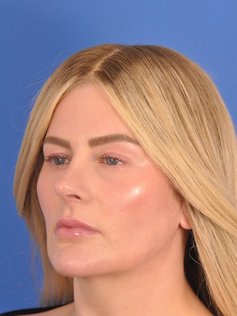 Rhinoplasty Before & After Gallery - Patient 180863483 - Image 8