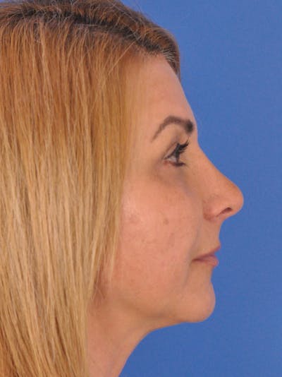 Rhinoplasty Before & After Gallery - Patient 180863715 - Image 2