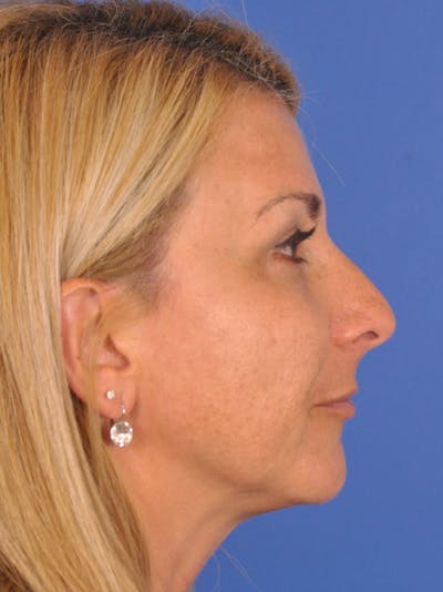 Rhinoplasty Before & After Gallery - Patient 180863715 - Image 1