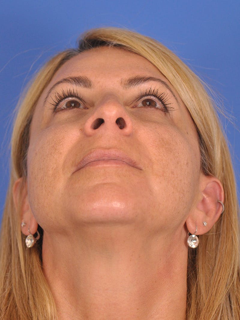 Rhinoplasty Before & After Gallery - Patient 180863715 - Image 11