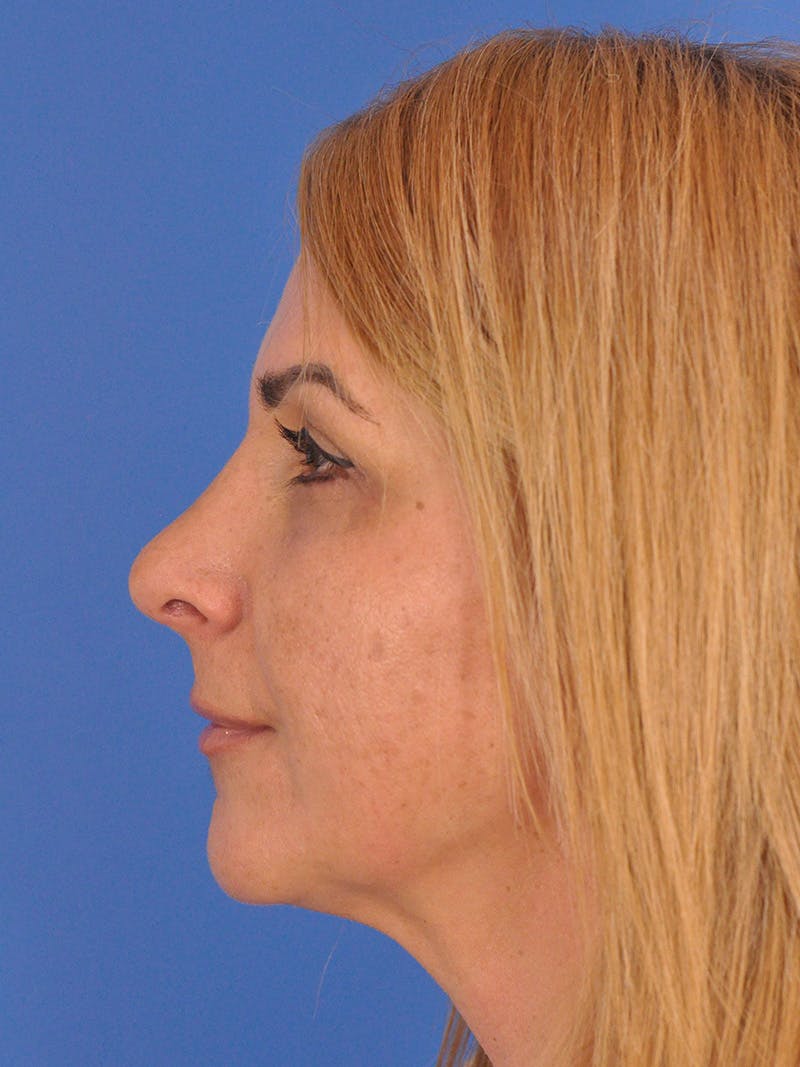 Rhinoplasty Before & After Gallery - Patient 180863715 - Image 10