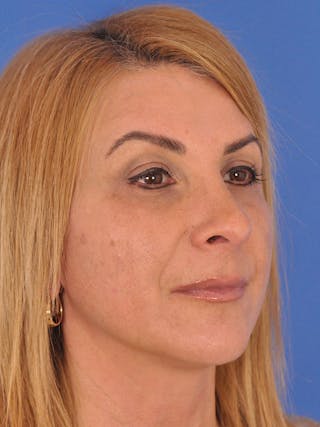 Rhinoplasty Before & After Gallery - Patient 180863715 - Image 6