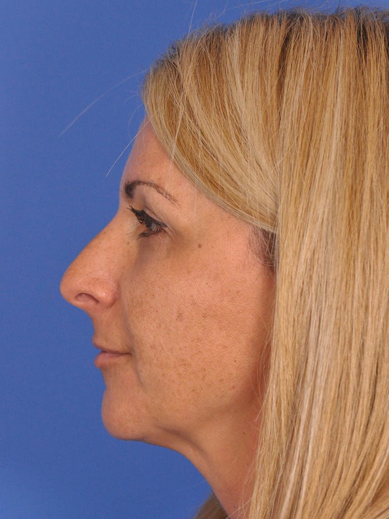 Rhinoplasty Before & After Gallery - Patient 180863715 - Image 9