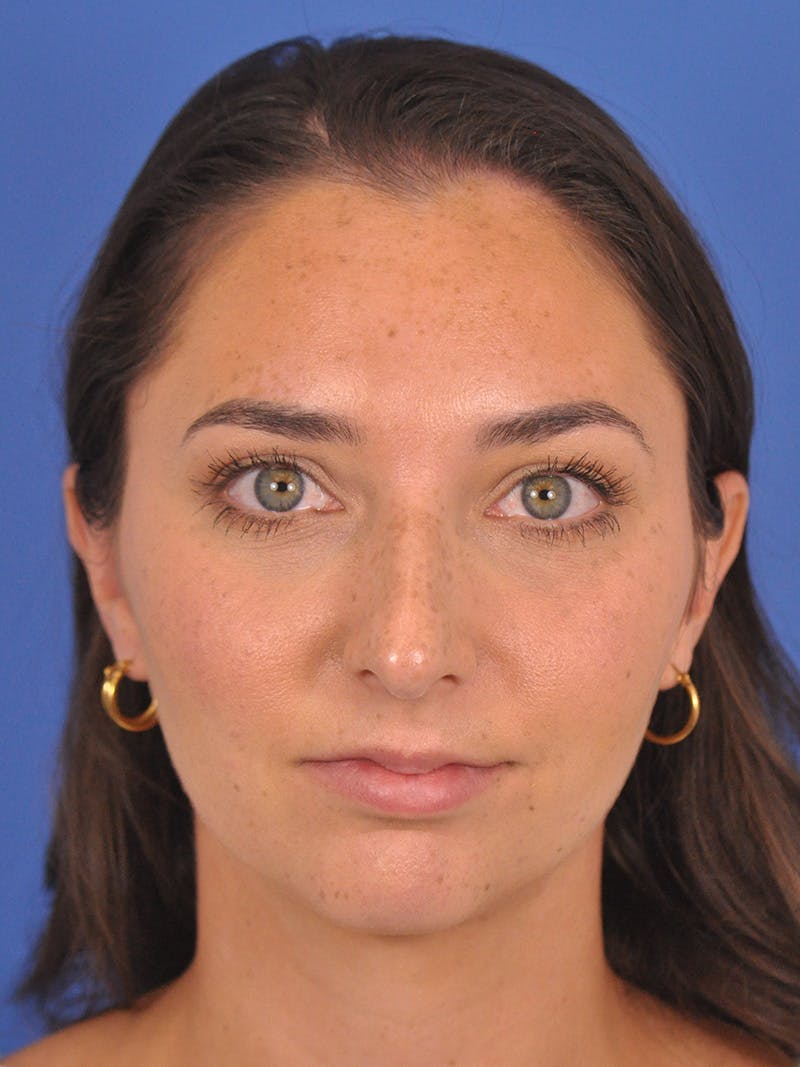 Rhinoplasty Before & After Gallery - Patient 180863822 - Image 3