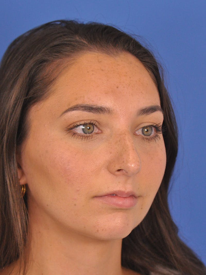 Rhinoplasty Before & After Gallery - Patient 180863822 - Image 5