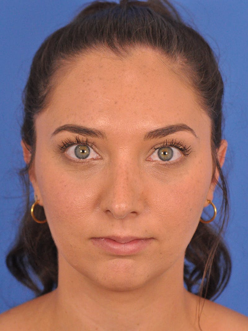 Rhinoplasty Before & After Gallery - Patient 180863822 - Image 4
