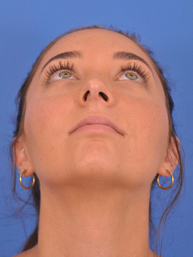 Rhinoplasty Before & After Gallery - Patient 180863822 - Image 12