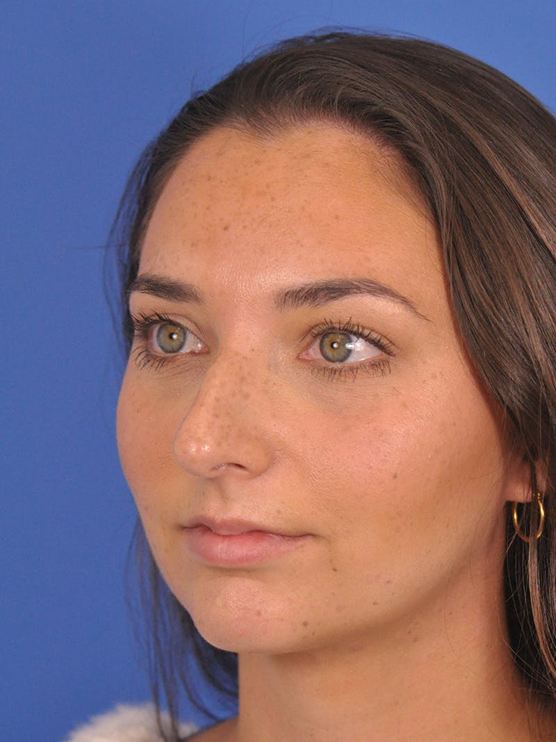 Rhinoplasty Before & After Gallery - Patient 180863822 - Image 7