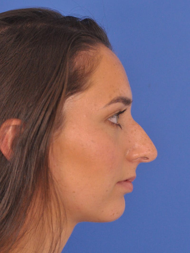 Rhinoplasty Before & After Gallery - Patient 180863822 - Image 1
