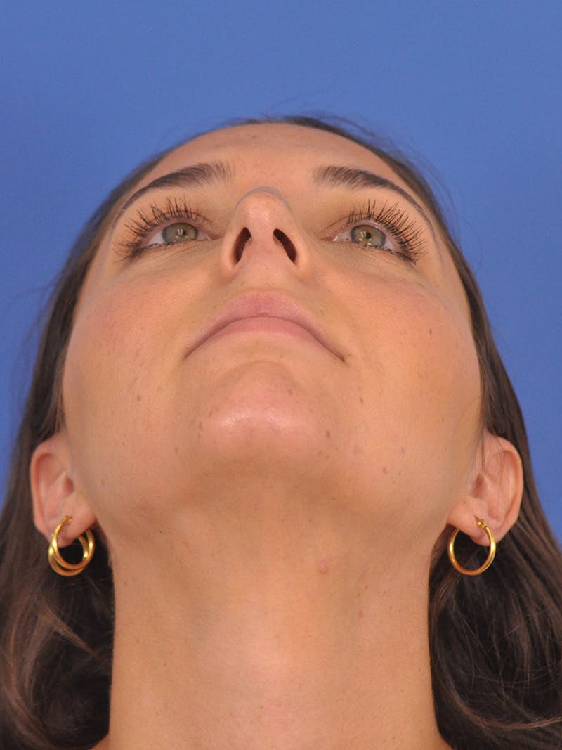 Rhinoplasty Before & After Gallery - Patient 180863822 - Image 11