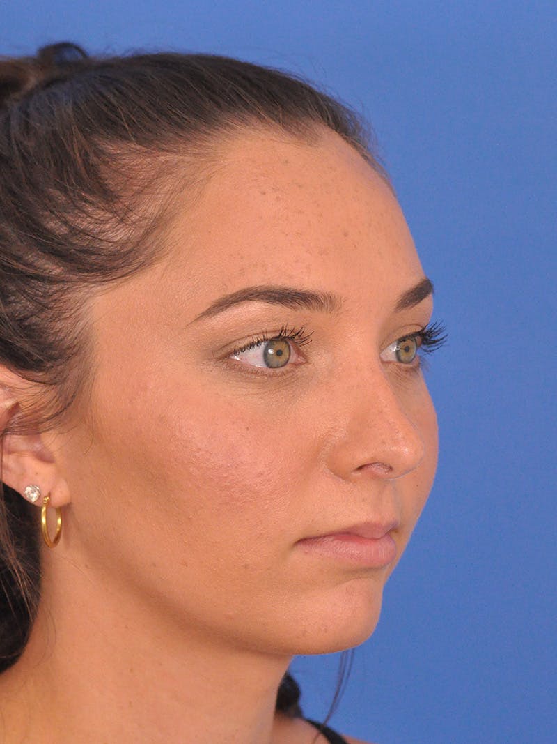 Rhinoplasty Before & After Gallery - Patient 180863822 - Image 6