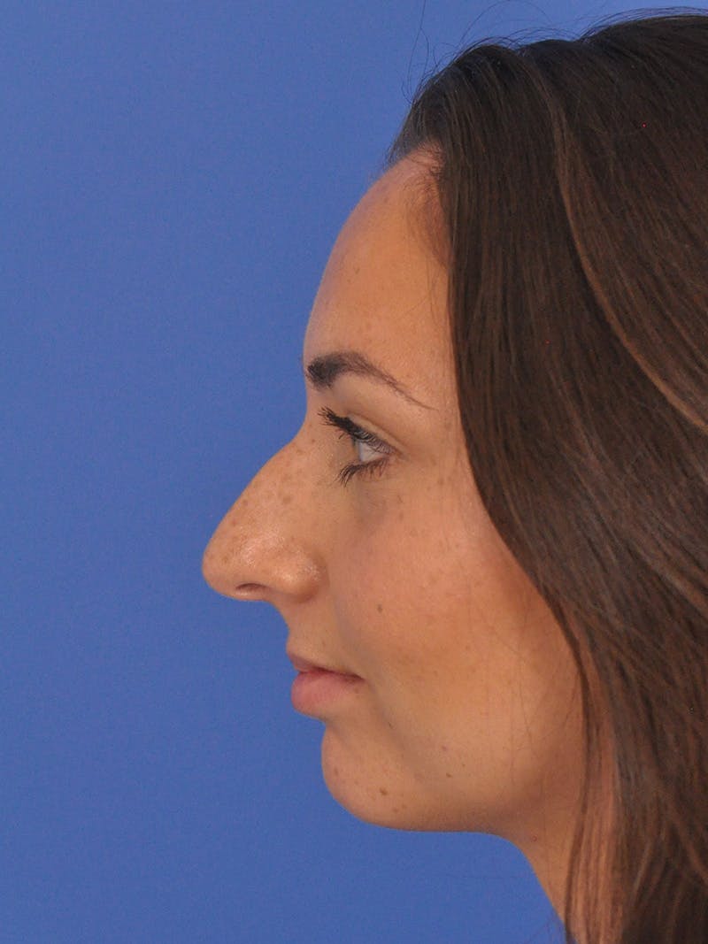 Rhinoplasty Before & After Gallery - Patient 180863822 - Image 9