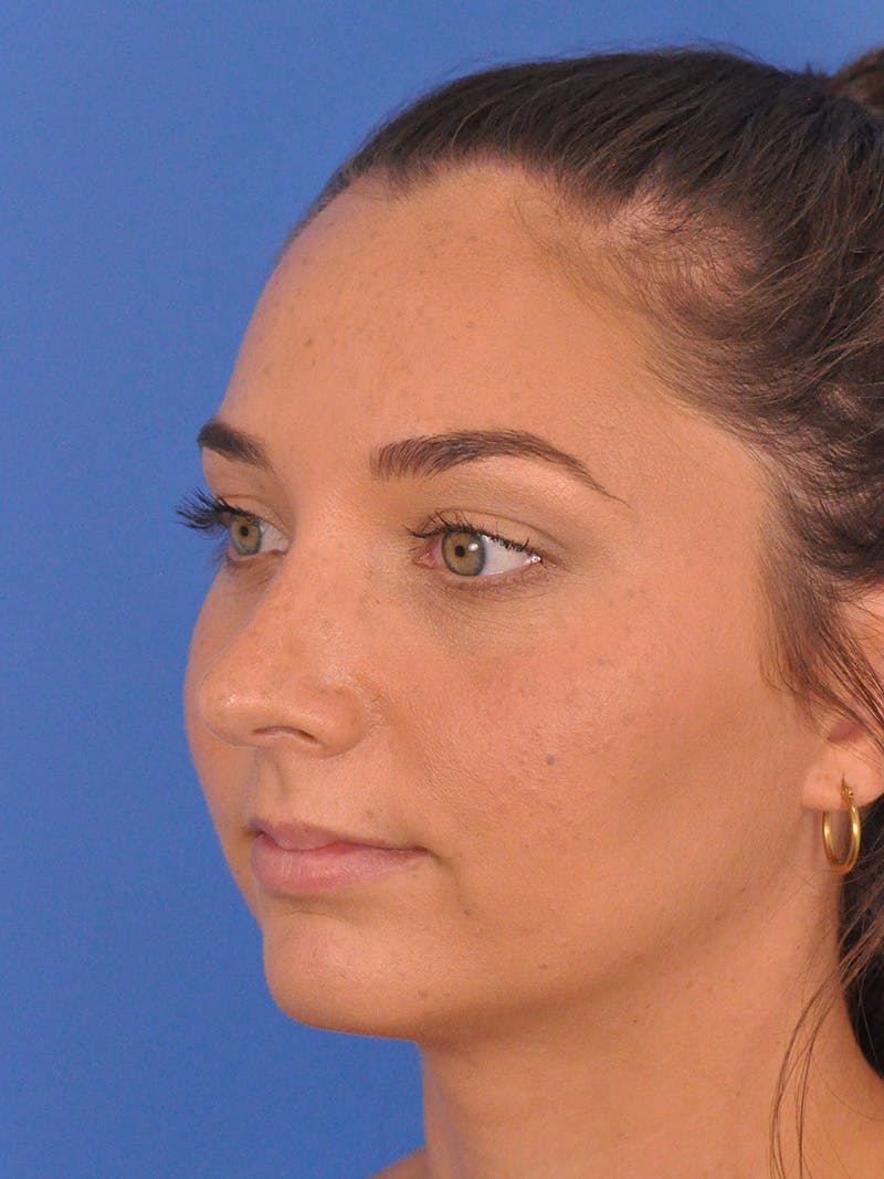 Rhinoplasty Before & After Gallery - Patient 180863822 - Image 8