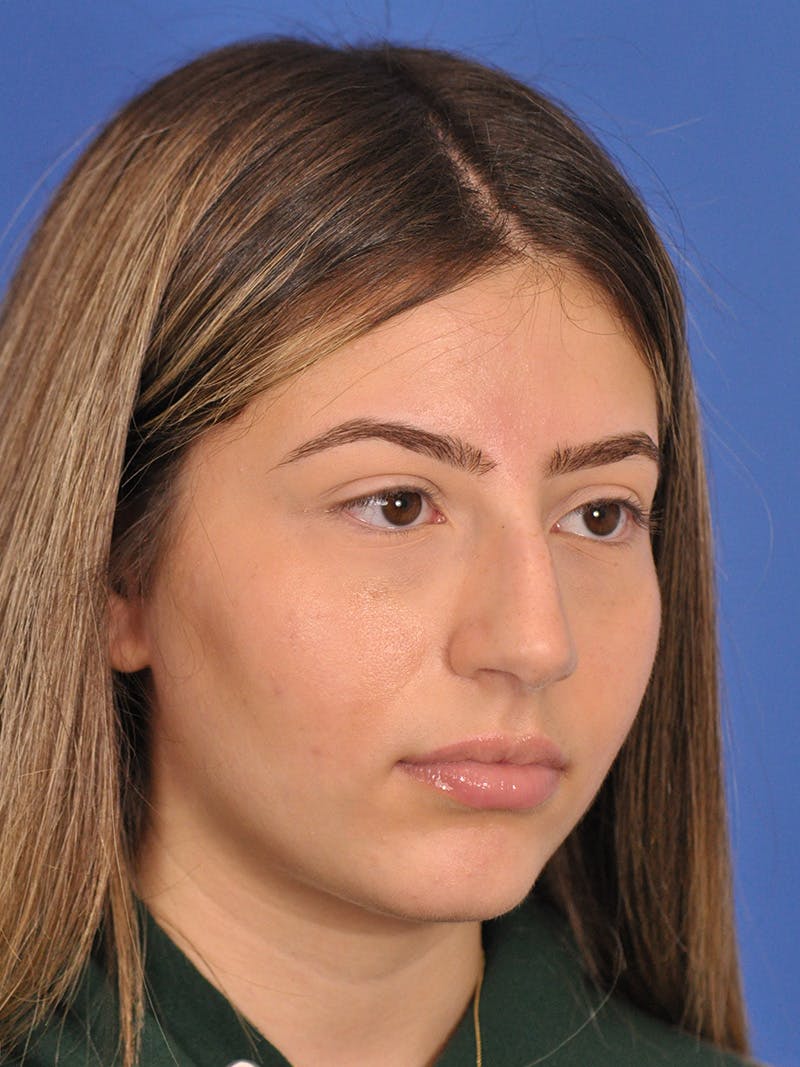 Rhinoplasty Before & After Gallery - Patient 180863861 - Image 5
