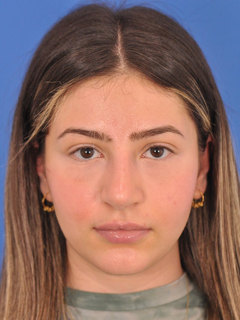 Rhinoplasty Before & After Gallery - Patient 180863861 - Image 4