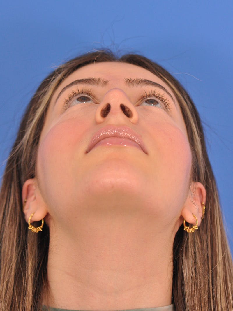 Rhinoplasty Before & After Gallery - Patient 180863861 - Image 12