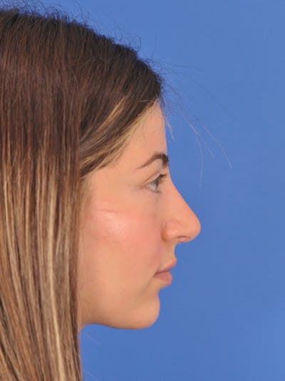 Rhinoplasty Before & After Gallery - Patient 180863861 - Image 2