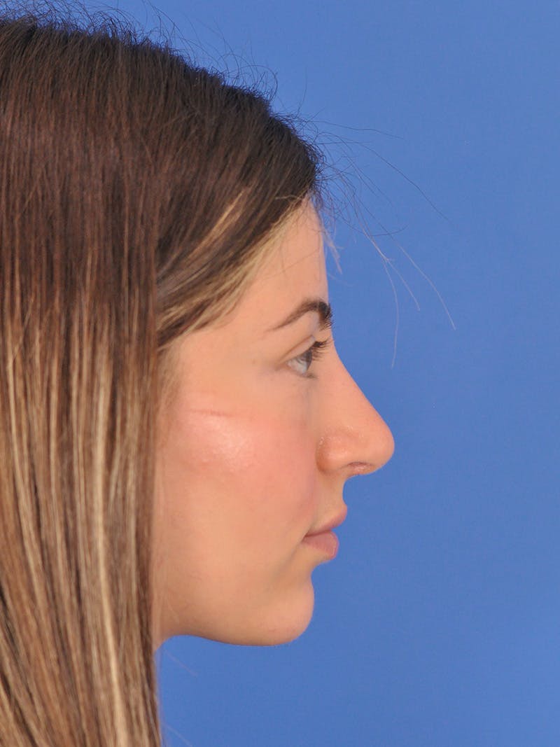 Rhinoplasty Before & After Gallery - Patient 180863861 - Image 2