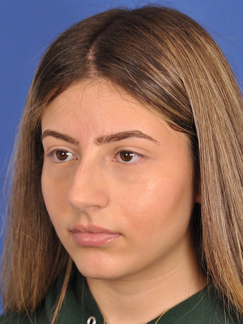 Rhinoplasty Before & After Gallery - Patient 180863861 - Image 7