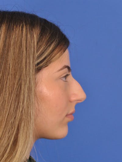 Rhinoplasty Before & After Gallery - Patient 180863861 - Image 1