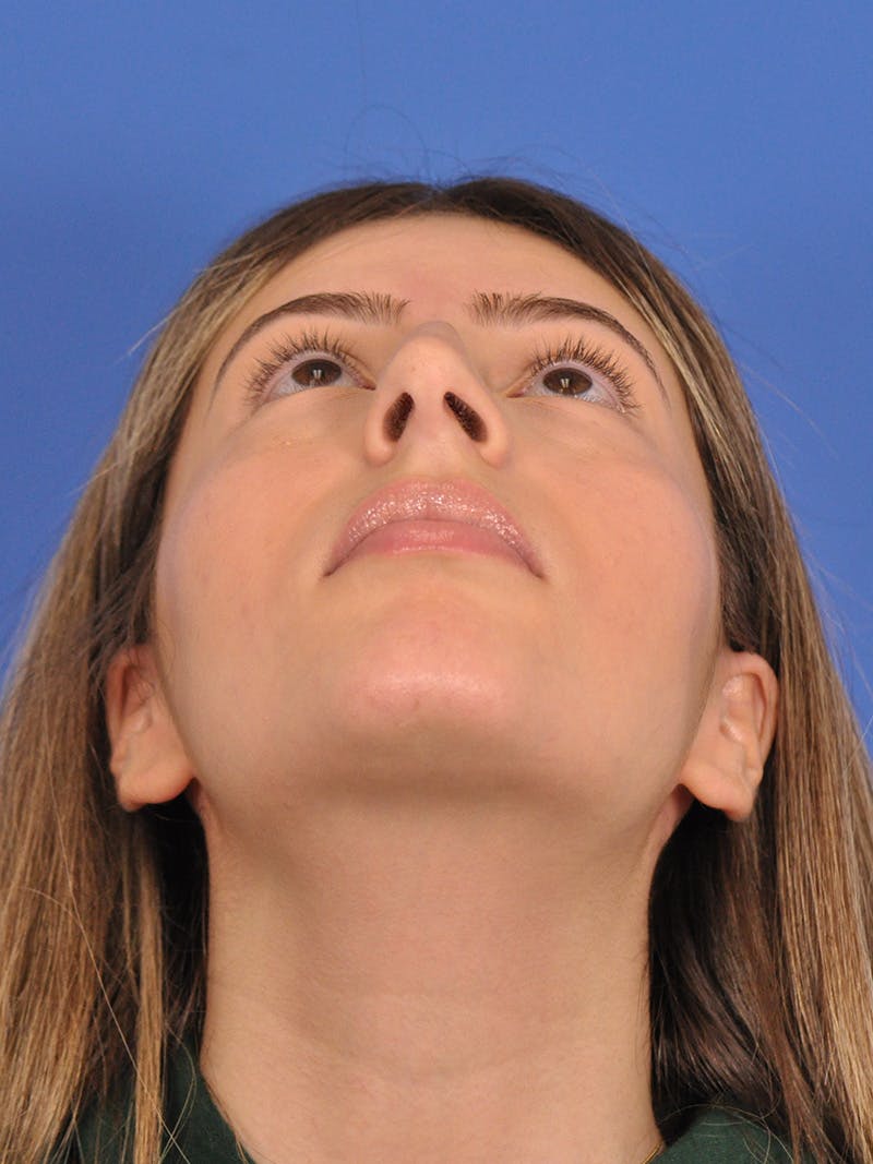 Rhinoplasty Before & After Gallery - Patient 180863861 - Image 11