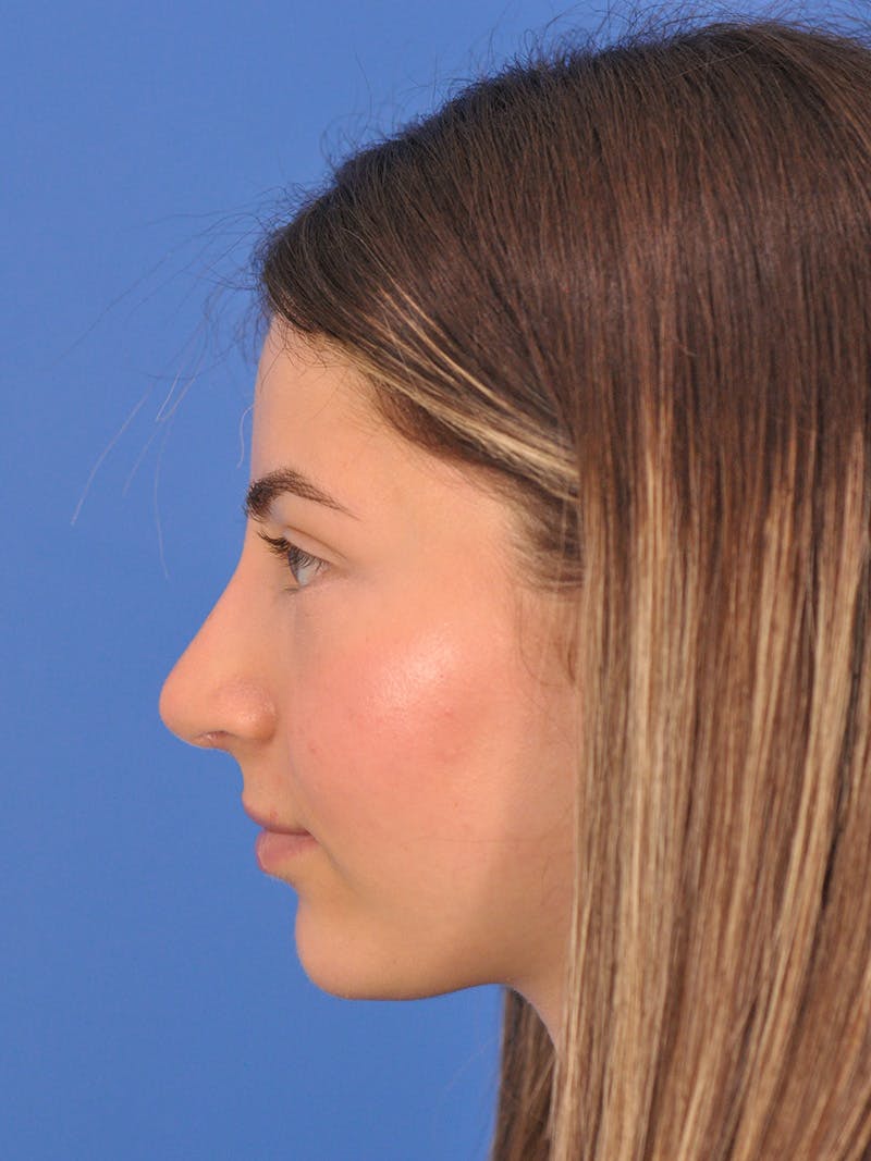 Rhinoplasty Before & After Gallery - Patient 180863861 - Image 10