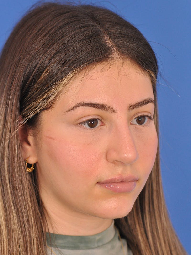 Rhinoplasty Before & After Gallery - Patient 180863861 - Image 6