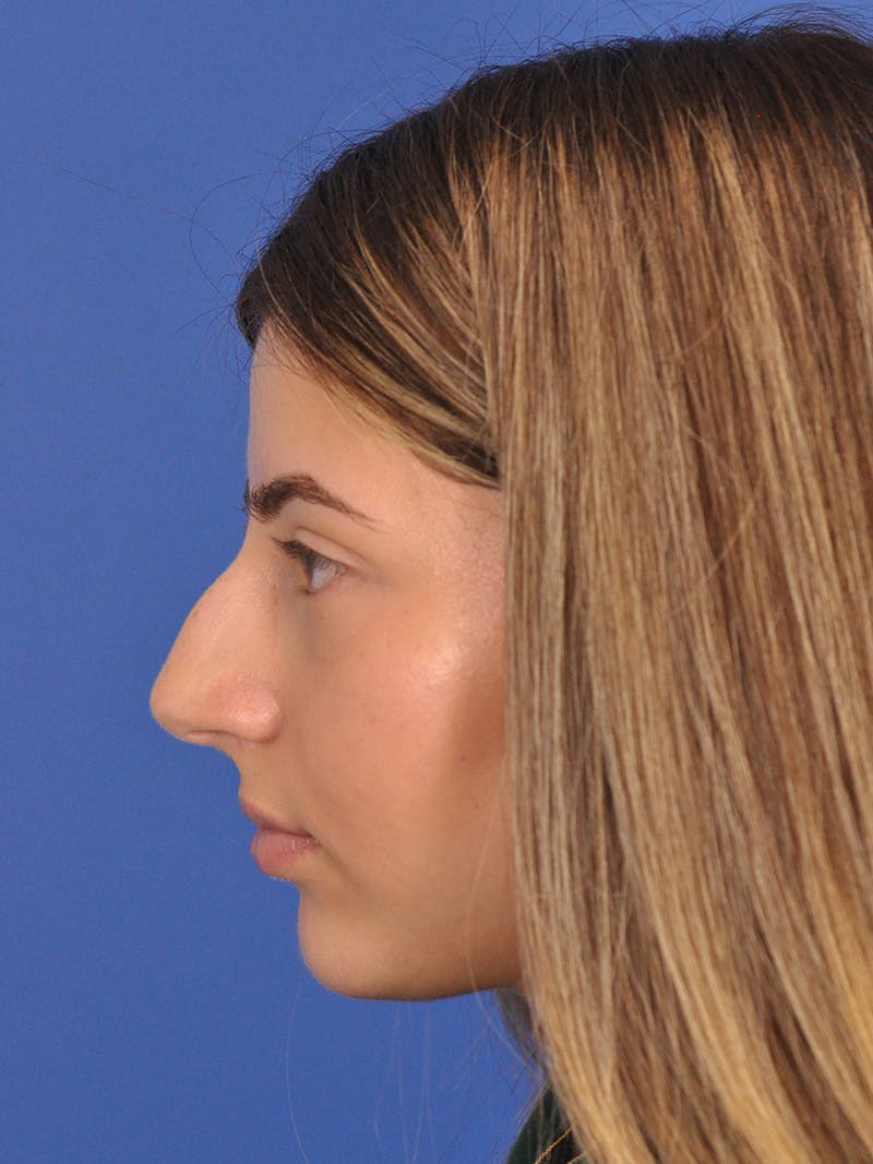 Rhinoplasty Before & After Gallery - Patient 180863861 - Image 9