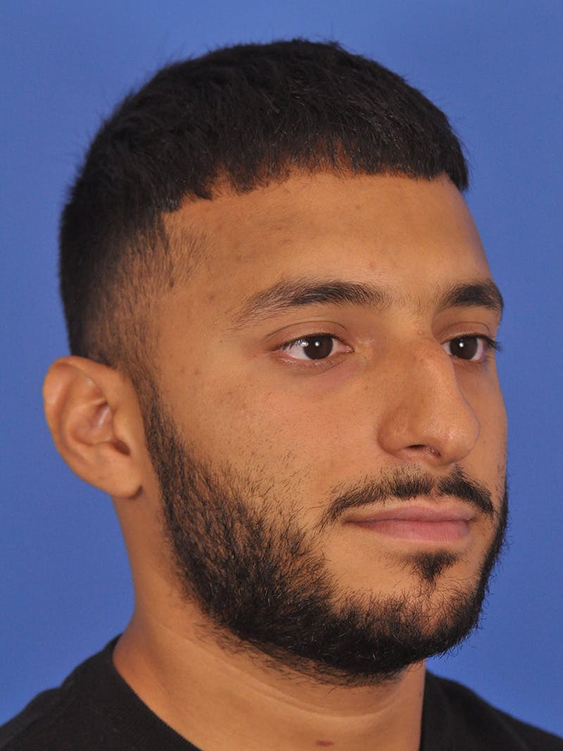 Rhinoplasty Before & After Gallery - Patient 180863863 - Image 5