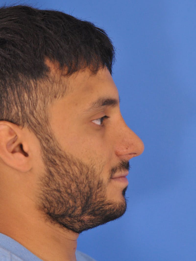 Rhinoplasty Before & After Gallery - Patient 180863863 - Image 2