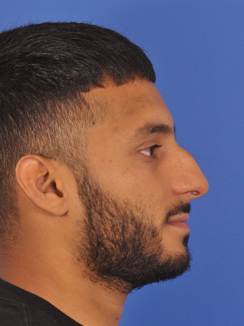 Rhinoplasty Before & After Gallery - Patient 180863863 - Image 1