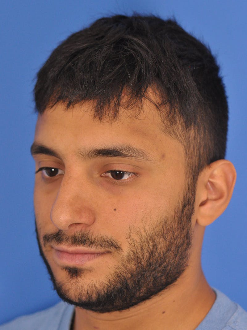 Rhinoplasty Before & After Gallery - Patient 180863863 - Image 8