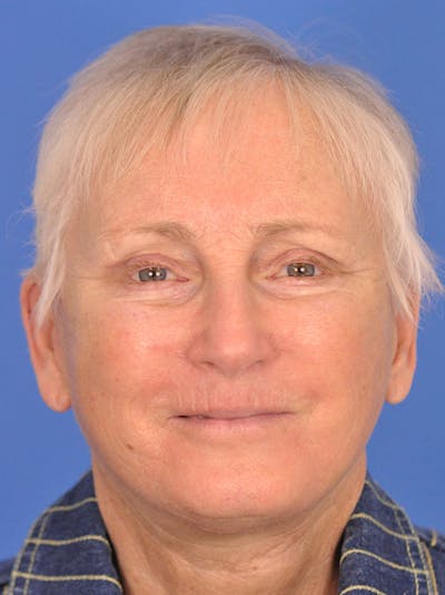 Brow Lift Before & After Gallery - Patient 180863867 - Image 1