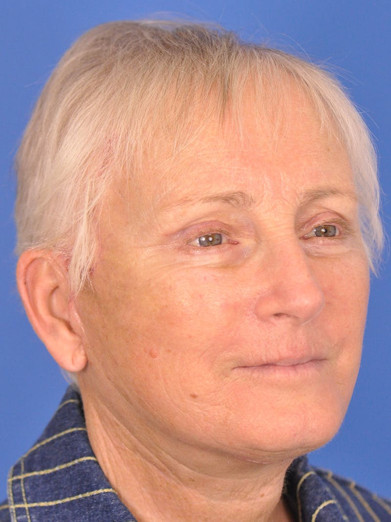 Brow Lift Before & After Gallery - Patient 180863867 - Image 3