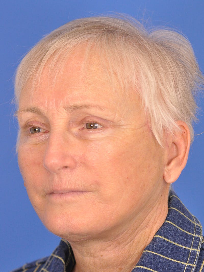 Brow Lift Before & After Gallery - Patient 180863867 - Image 7