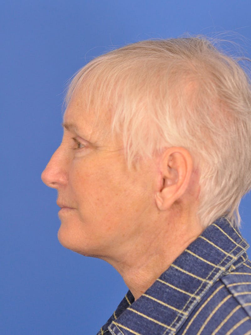 Brow Lift Before & After Gallery - Patient 180863867 - Image 9