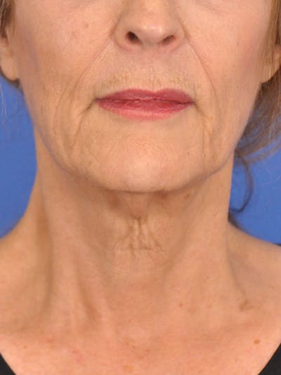 Facelift Before & After Gallery - Patient 110390 - Image 1