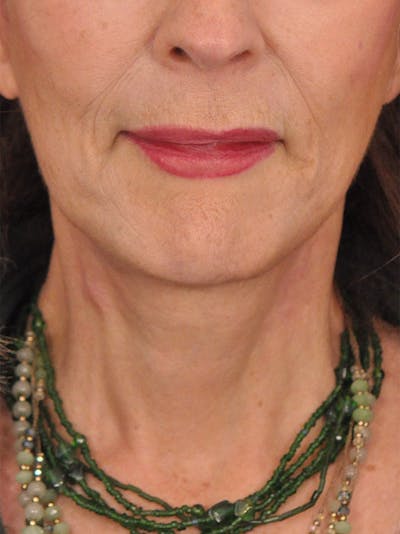 Facelift Before & After Gallery - Patient 110390 - Image 2