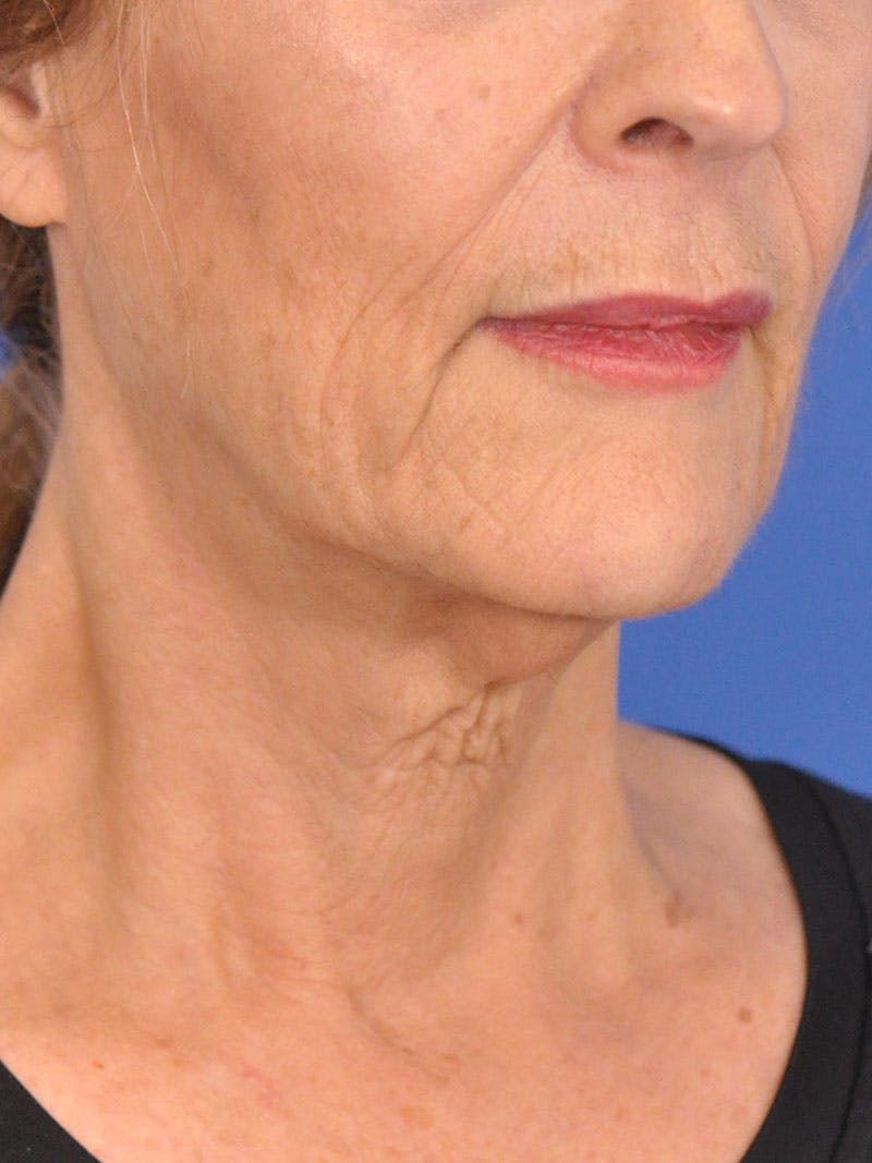 Facelift Before & After Gallery - Patient 110390 - Image 3