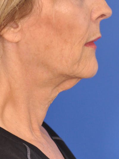 Neck Lift Before & After Gallery - Patient 165509 - Image 1
