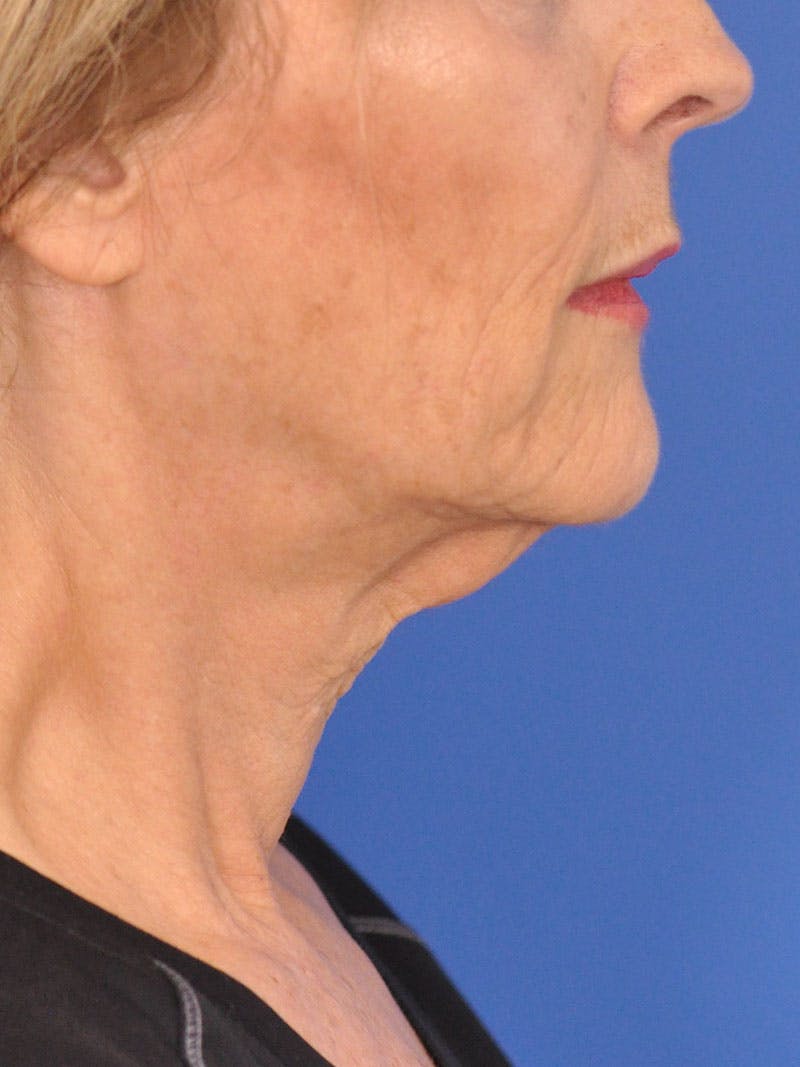 Facelift Before & After Gallery - Patient 110390 - Image 5