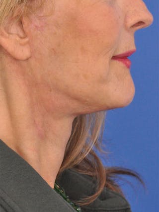 Neck Lift Before & After Gallery - Patient 165509 - Image 2
