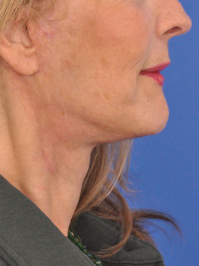 Facelift Before & After Gallery - Patient 110390 - Image 6