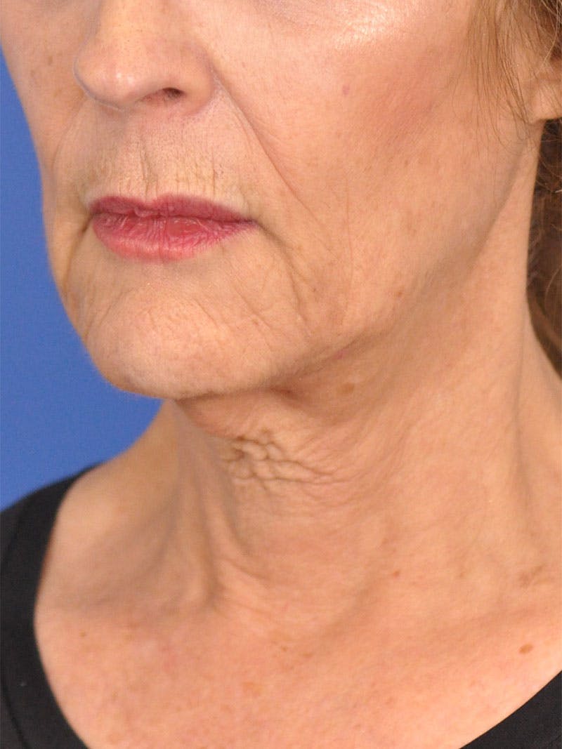 Facelift Before & After Gallery - Patient 110390 - Image 7