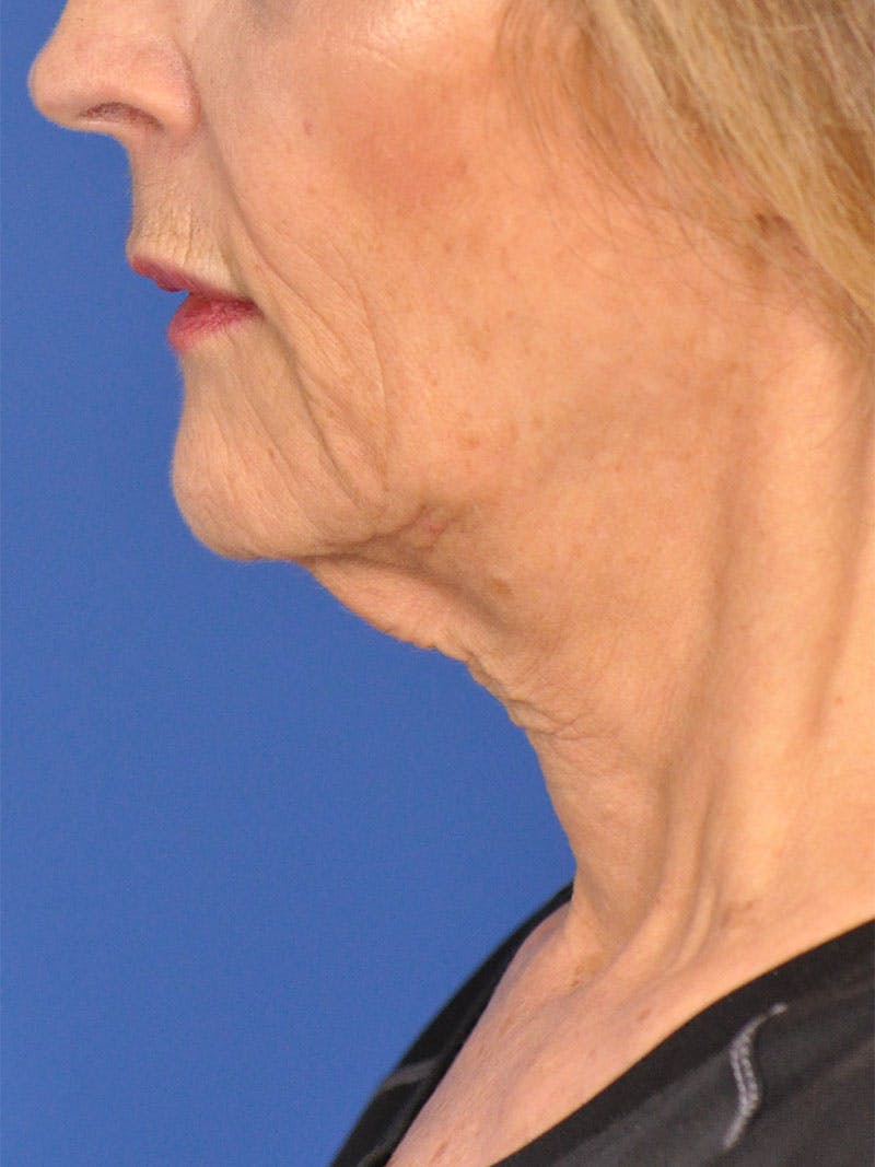 Neck Lift Before & After Gallery - Patient 165509 - Image 9
